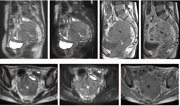 Pelvic MRI series showing a large rectal mass in a young postpartum patient