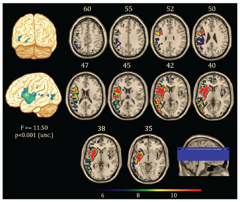 Brain renderings and axial slices highlighting regions where CT values differ between aphasic and non-aphasic patients