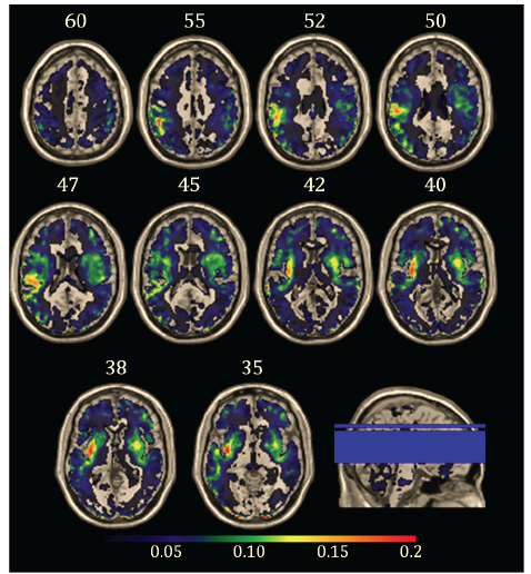 Axial brain slices with a colour overlay showing where strokes overlapped across eighty patients