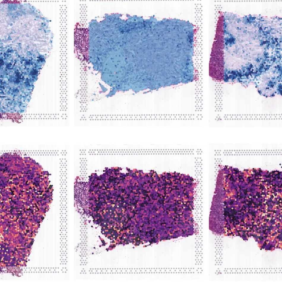 Whole slide tissue sections of small cell lung cancer with spatial T cell identity and dysfunction scores overlaid